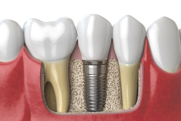 Anatomy of healthy teeth and tooth dental implant in human dentura. 3d illustration